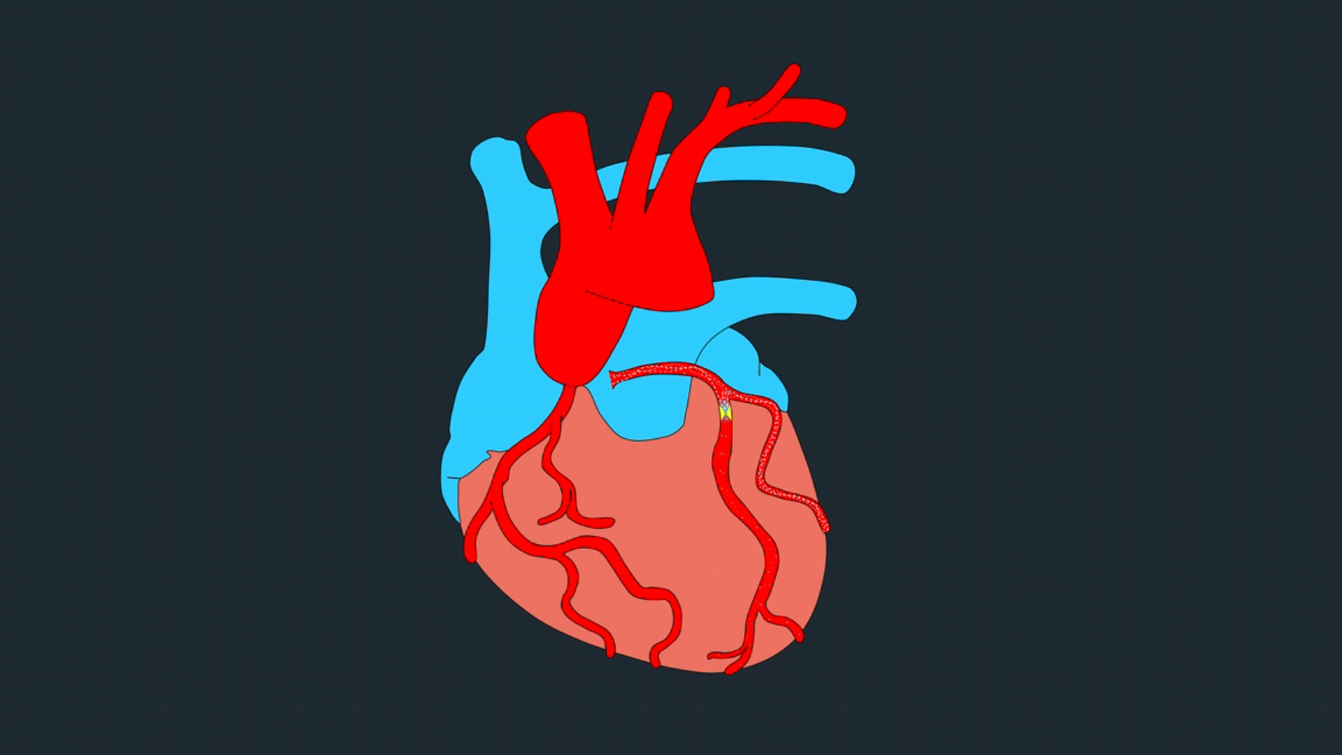 Animated heart establishing the coronary anatomy