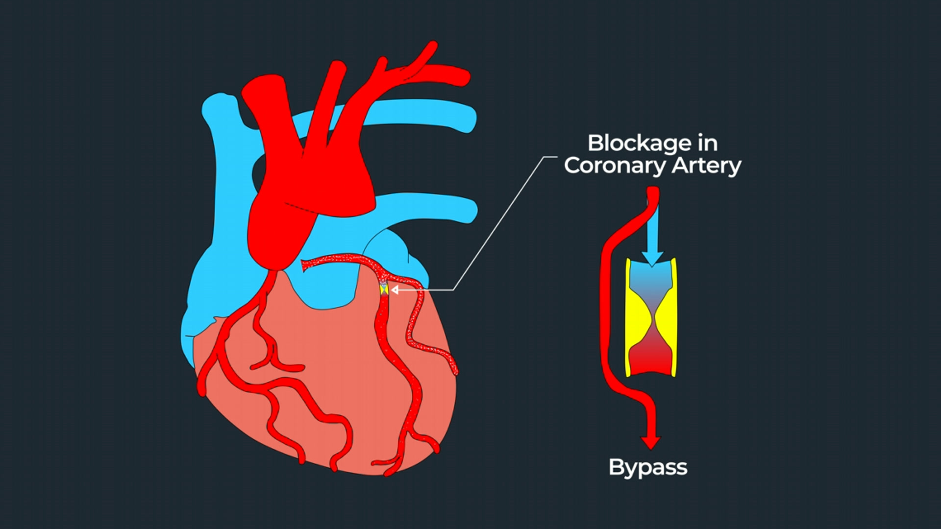 Close-up diagram showing restricted blood flow around the blockage