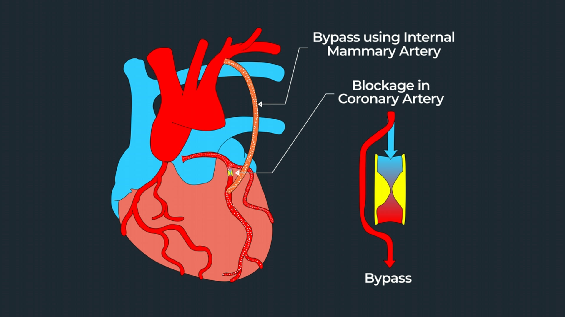 Coronary bypass animated explainer